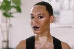 Модель с витилиго стала лицом международного косметического бренда