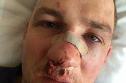 Юрій Левченко після побиття