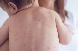 На Закарпатті минулого тижня 141 людина захворіла на кір