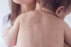 Кір не відступає від Києва: в яких районах найбільше хворих 