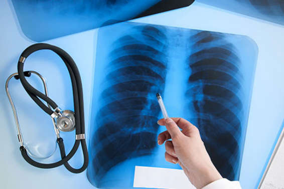 Безкоштовне обстеження на туберкульоз проведуть у Вінниці
