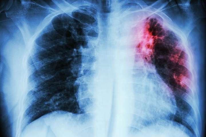 Литва і Румунія – перші у ЄС за рівнем захворюваності на туберкульоз