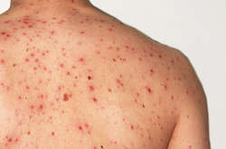 У віськових частинах на Київщині масове захворювання на кір 