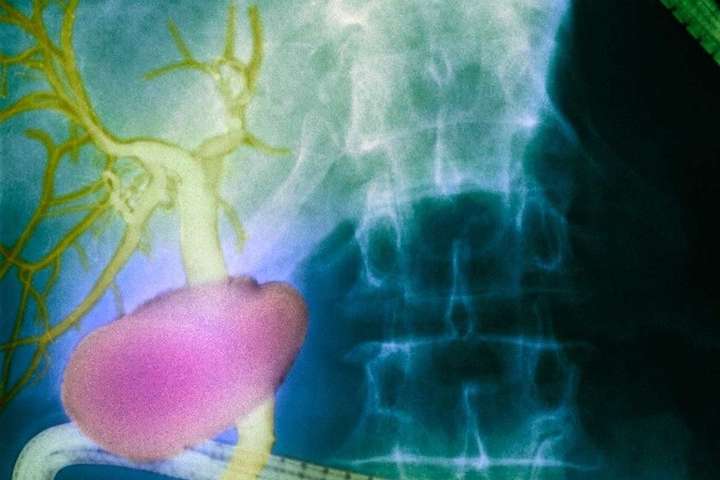 У тілі людини виявили невідомий орган, по якому поширюється рак