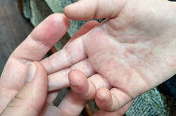 В Україні за тиждень на кір захворіли близько 700 людей 