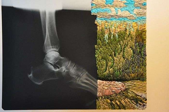 Оригінальний фотопроект: художник з США доповнює рентгенівські знімки вишивкою