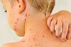 У Львові трирічна дитина померла від кору