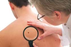 У Всеукраїнський день меланоми киян запрошують перевіритися на рак (адреси)