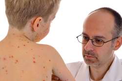 У Київській області зафіксовано спалах кору