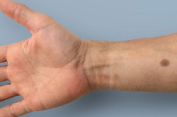 Ученые придумали тату, предупреждающее о раке