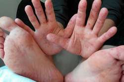 У квітні у Києві різко зросла захворюваність на кір