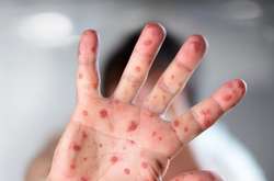 Зафіксовано спалах кору у столичному відділенні психіатрії та школі