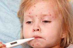 В Киеве больше двухсот человек заболели корью за неделю