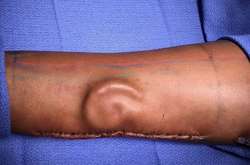 В США врачи вырастили женщине-солдату новое ухо на ее предплечье