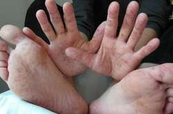 У Кіровоградській області підтвердили майже 180 випадків кору