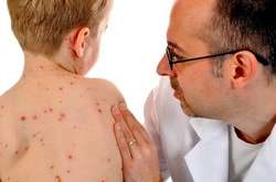 Названо райони Києва, де найбільше хворих на кір