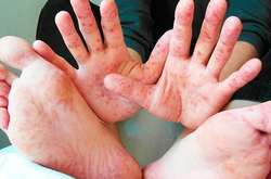 Цього тижня на кір захворіли 1610 українців