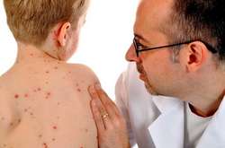 В Україні зросла кількість хворих на кір