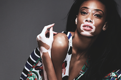 Как живут люди с «болезнью Майкла Джексона»