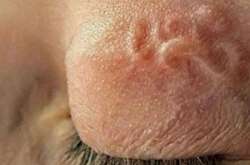 На Полтавщині у жінки з ока дістали 12-сантиметрового хробака