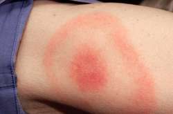 Супрун розказала, як виявити хворобу Лайма