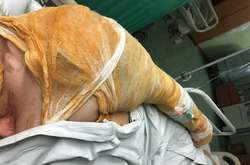 Херсонська активістка, яка постраждала від кислоти, розказала про напад 