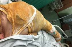 Гандзюк госпіталізували в реанімацію Київського опікового центру