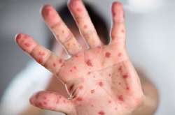 Новий спалах кору: за тиждень в Україні захворіли майже 800 людей 