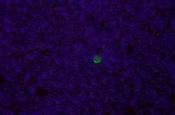  VAR2CSA підсвічує ракову клітину 