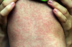В Україні за тиждень на кір захворіло понад 500 осіб