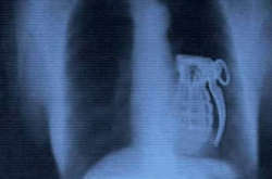 Жуткие находки, которые врачи нашли в человеческих желудках