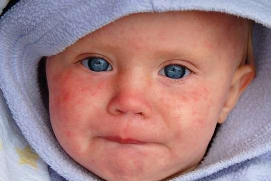 В Україні у немовлят фіксують вроджений кір