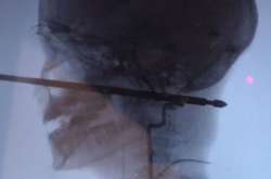 10-летний мальчик выжил после того, как через его голову насквозь прошел шампур для шашлыка