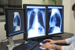 Київ купить цифровий рентген для діагностування туберкульозу