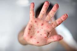  Ведеться епідеміологічне дослідження щодо джерела зараження 