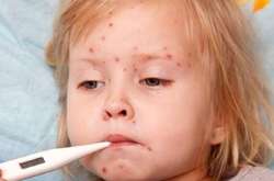 Сусідні країни стривожені через спалах кору в Україні