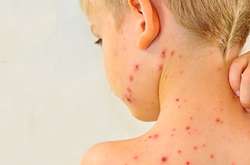 Захворюваність на кір може досягти найвищого показника за 12 років