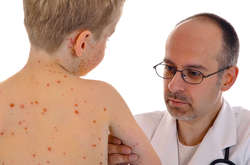 Число больных корью в Украине в этом году может стать рекордным