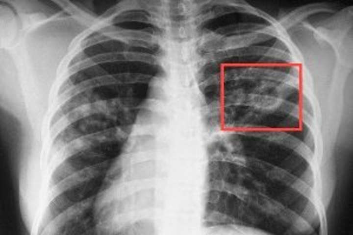В Україні впровадили нові методи діагностики туберкульозу