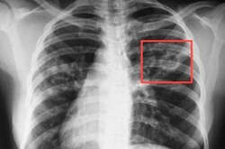  В Україні впроваджують молекулярно-генетичний метод діагностики туберкульозу   