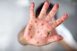 Через спалах кору на Львівщині закрито чотири школи 