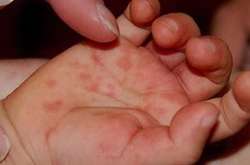 Серед хворих на кір у Броварах четверо дітей