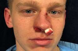 Олександр Зінченко відразу після травми