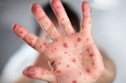 На Одещині у школі стався спалах кору