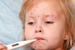 З початку року у Києві на кір занедужало більше тисячі дітей