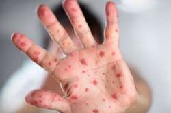 «Померлому хлопчику був лише рік і три місяці, він став третьою дитиною в Одесі, яка померла від кору з початку 2018 року», - інформує видання