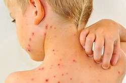 З початку року на кір захворіли вже близько 47 тисяч українців