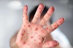 На стаціонарне лікування потрапили четверо хворих на кір