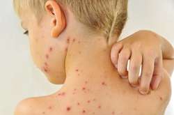 Лікарі б’ють на сполох: хвиля кору накриває Вінниччину