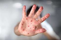 На Харківщині зафіксували спалахи кору